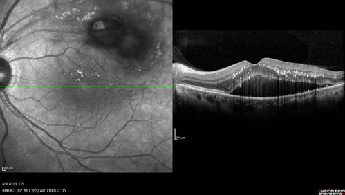 Retinal Arterial Macroaneurysm - Untreated Hypertension (250/135) - Serous Macular Detachment
82 year old asian woman.  VA 20/80 Headaches and vision loss for 1 month.  Negative medical history but has not been to the doctor for years. (no insurance)
