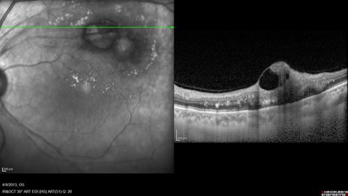 Retinal Arterial Macroaneurysm - Untreated Hypertension (250/135) - Serous Macular Detachment
82 year old asian woman.  VA 20/80 Headaches and vision loss for 1 month.  Negative medical history but has not been to the doctor for years. (no insurance)
