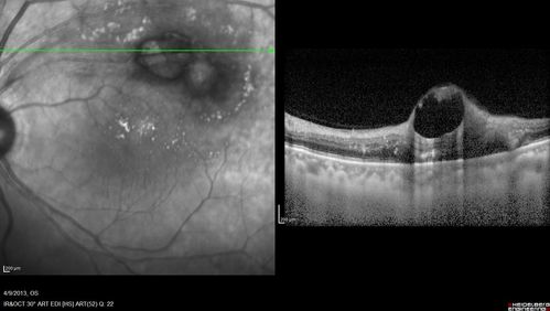 Retinal Arterial Macroaneurysm - Untreated Hypertension (250/135) - Serous Macular Detachment
82 year old asian woman.  VA 20/80 Headaches and vision loss for 1 month.  Negative medical history but has not been to the doctor for years. (no insurance)
