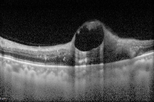 Retinal Arterial Macroaneurysm - Untreated Hypertension (250/135) - Serous Macular Detachment
82 year old asian woman.  VA 20/80 Headaches and vision loss for 1 month.  Negative medical history but has not been to the doctor for years. (no insurance)
