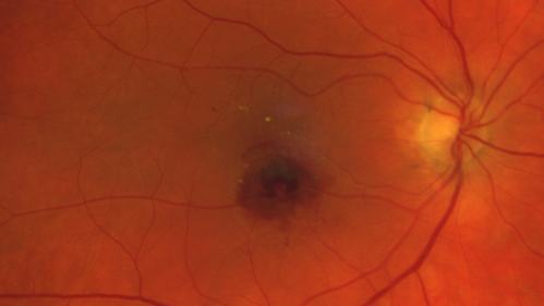 Retinal Arterial Macroaneursym
69 year old female with vision loss for a few months in the right eye.  Images show a macroaneurysm in the right eye.  The lesion had bled and FA showed no leakage.  No treatment was done.  VA improved from 20/40 - 20/32
