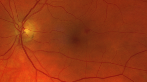Retinal Arterial Macroaneursym
69 year old female with vision loss for a few months in the right eye.  Images show a macroaneurysm in the right eye.  The lesion had bled and FA showed no leakage.  No treatment was done.  VA improved from 20/40 - 20/32
