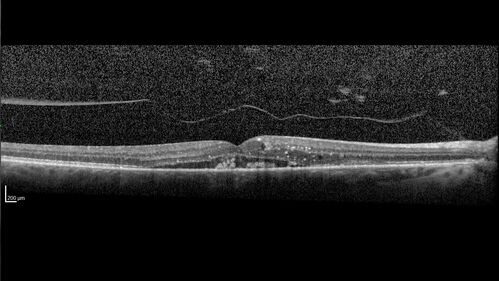 Retinal Arterial Macroaneursym
69 year old female with vision loss for a few months in the right eye.  Images show a macroaneurysm in the right eye.  The lesion had bled and FA showed no leakage.  No treatment was done.  VA improved from 20/40 - 20/32
