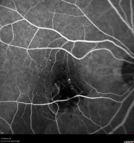 Retinal Arterial Macroaneursym
69 year old female with vision loss for a few months in the right eye.  Images show a macroaneurysm in the right eye.  The lesion had bled and FA showed no leakage.  No treatment was done.  VA improved from 20/40 - 20/32
