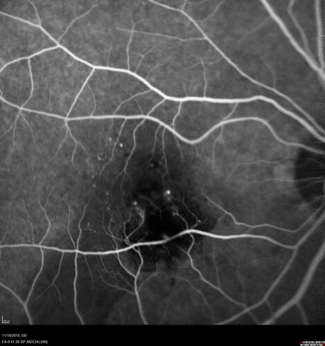 Retinal Arterial Macroaneursym
69 year old female with vision loss for a few months in the right eye.  Images show a macroaneurysm in the right eye.  The lesion had bled and FA showed no leakage.  No treatment was done.  VA improved from 20/40 - 20/32
