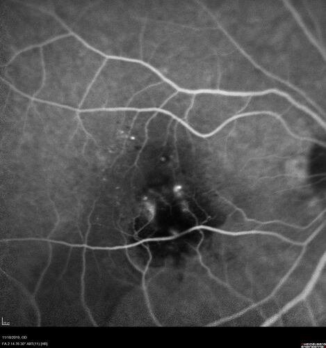 Retinal Arterial Macroaneursym
69 year old female with vision loss for a few months in the right eye.  Images show a macroaneurysm in the right eye.  The lesion had bled and FA showed no leakage.  No treatment was done.  VA improved from 20/40 - 20/32
