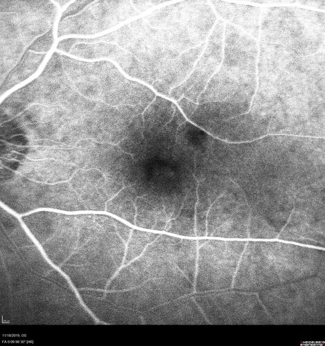 Retinal Arterial Macroaneursym
69 year old female with vision loss for a few months in the right eye.  Images show a macroaneurysm in the right eye.  The lesion had bled and FA showed no leakage.  No treatment was done.  VA improved from 20/40 - 20/32
