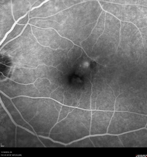 Retinal Arterial Macroaneursym
69 year old female with vision loss for a few months in the right eye.  Images show a macroaneurysm in the right eye.  The lesion had bled and FA showed no leakage.  No treatment was done.  VA improved from 20/40 - 20/32
