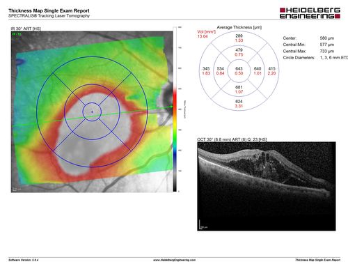 Self Sealed Retinal Arteriol Macroaneurysm
MAP shows edema and some subretinal fluid
