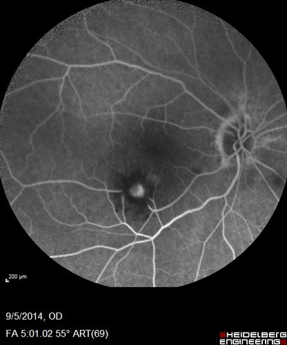 Self Sealed Retinal Arteriol Macroaneurysm
FA on presentation showed minimal to no active leakage.  Also, there is a small cuff of blood around the MA which is favorable for closure
