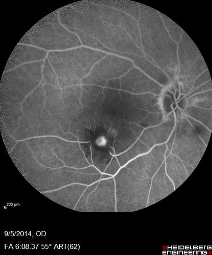 Self Sealed Retinal Arteriol Macroaneurysm
FA on presentation showed minimal to no active leakage.  Also, there is a small cuff of blood around the MA which is favorable for closure
