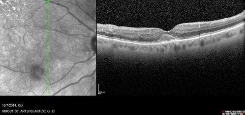 Self Sealed Retinal Arteriol Macroaneurysm - one month after presentation - edema nearly gone
SD OCT line scan
