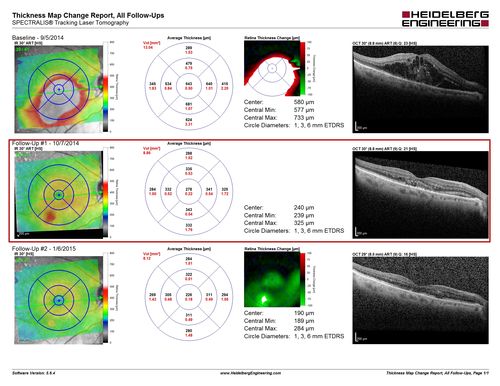 Self Sealed Retinal Arteriol Macroaneurysm - MAP shows decreased swelling
SD OCT map
