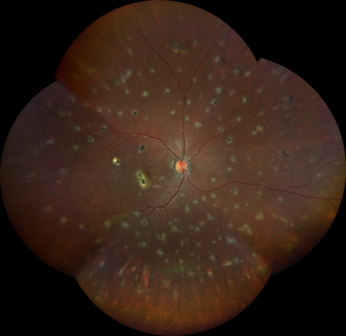 Multifocal Choroiditis and Subretinal Fibrosis with new Subretinal Neovascular Membrane
26 year old African American Girl Saw me at age 10 (16 years ago) with acute multifocal choroiditis and panuveitis which evolved into subretinal fibrosis. She was initially treated with 3 years of methotrexate. Vision ended up 20/20 in both eyes. Her eyes have been inactive since and she was lost to follow-up. 
 A week ago she noticed sudden decreased vision in the right eye.  Within the past few weeks there are more floaters in the right eye.  
VA OD: sc6â€™/200 PHNI
VA OS: sc20/16
