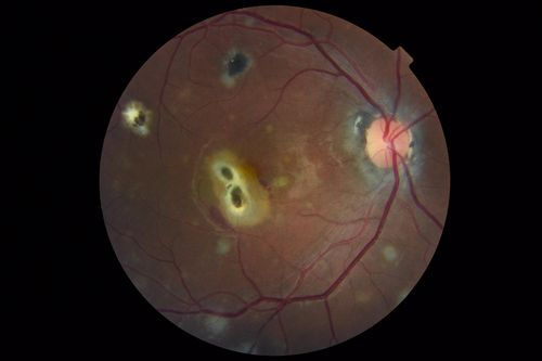 Multifocal Choroiditis and Subretinal Fibrosis with new Subretinal Neovascular Membrane
26 year old African American Girl Saw me at age 10 (16 years ago) with acute multifocal choroiditis and panuveitis which evolved into subretinal fibrosis. She was initially treated with 3 years of methotrexate. Vision ended up 20/20 in both eyes. Her eyes have been inactive since and she was lost to follow-up. 
 A week ago she noticed sudden decreased vision in the right eye.  Within the past few weeks there are more floaters in the right eye.  
VA OD: sc6â€™/200 PHNI
VA OS: sc20/16

