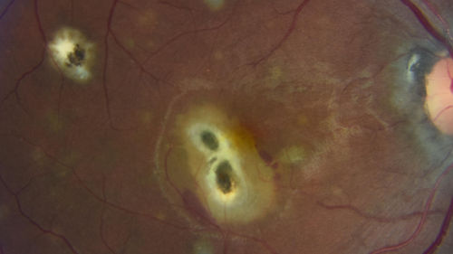 Multifocal Choroiditis and Subretinal Fibrosis with new Subretinal Neovascular Membrane
26 year old African American Girl Saw me at age 10 (16 years ago) with acute multifocal choroiditis and panuveitis which evolved into subretinal fibrosis. She was initially treated with 3 years of methotrexate. Vision ended up 20/20 in both eyes. Her eyes have been inactive since and she was lost to follow-up. 
 A week ago she noticed sudden decreased vision in the right eye.  Within the past few weeks there are more floaters in the right eye.  
VA OD: sc6â€™/200 PHNI
VA OS: sc20/16
