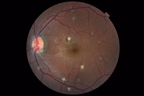 Multifocal Choroiditis and Subretinal Fibrosis with new Subretinal Neovascular Membrane
26 year old African American Girl Saw me at age 10 (16 years ago) with acute multifocal choroiditis and panuveitis which evolved into subretinal fibrosis. She was initially treated with 3 years of methotrexate. Vision ended up 20/20 in both eyes. Her eyes have been inactive since and she was lost to follow-up. 
 A week ago she noticed sudden decreased vision in the right eye.  Within the past few weeks there are more floaters in the right eye.  
VA OD: sc6â€™/200 PHNI
VA OS: sc20/16
