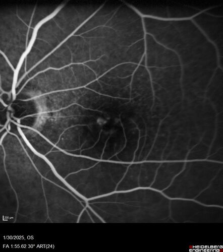 Conversion to Wet AMD after Izervay
83 year  old  man whose  left eye had minimal GA and converted from dry to wet AMD after a single Izervay treatment
