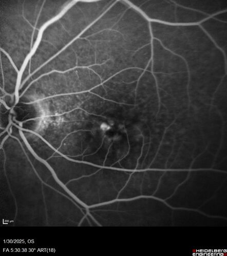 Conversion to Wet AMD after Izervay
83 year  old  man whose  left eye had minimal GA and converted from dry to wet AMD after a single Izervay treatment
