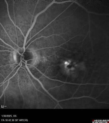 Conversion to Wet AMD after Izervay
83 year  old  man whose  left eye had minimal GA and converted from dry to wet AMD after a single Izervay treatment
