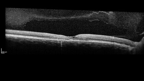 Macular Telangetasia MacTel - Nonproliferative
60 year old non-diabetic female with gradual vision loss for 20 years.  VA 20/80 OD, 20/63 OS
