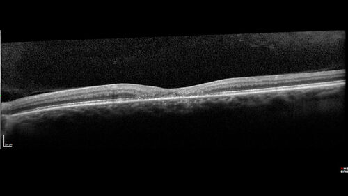Macular Telangetasia MacTel - Nonproliferative
60 year old non-diabetic female with gradual vision loss for 20 years.  VA 20/80 OD, 20/63 OS
