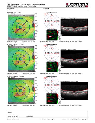 Non-exudative neovascular AMD right eye
Vision 20/20 at 6 year follow-up - no exudation
