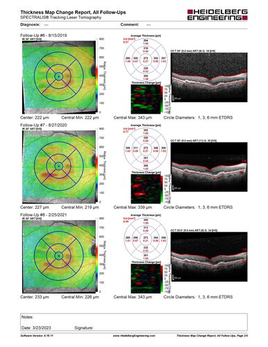 Non-exudative neovascular AMD right eye
Vision 20/20 at 6 year follow-up - no exudation
