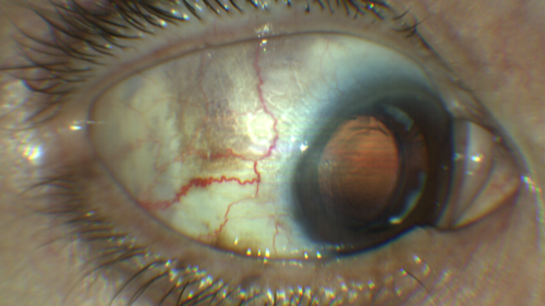 Melanosis Oculi and Choroidal Melanoma
88 year old female with 2.5 mm elevated choroidal melanoma and melanosis oculi.  She also has geographic atrophy from AMD.  The right eye is the better eye with 20/40 vision.  After observation with growth, brachytherapy was done.
