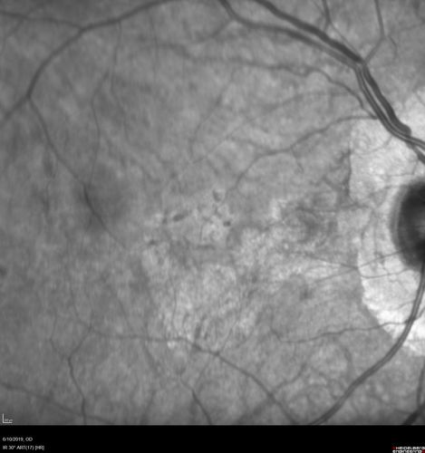 Melanosis Oculi and Choroidal Melanoma
88 year old female with 2.5 mm elevated choroidal melanoma and melanosis oculi.  She also has geographic atrophy from AMD.  The right eye is the better eye with 20/40 vision.  After observation with growth, brachytherapy was done.
