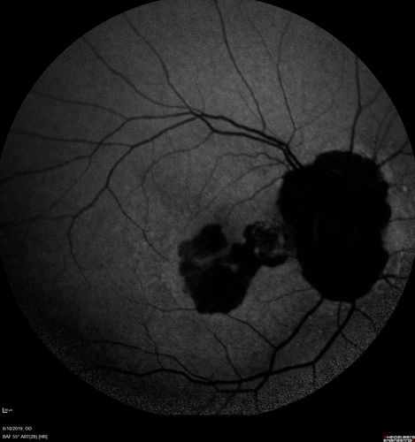 Melanosis Oculi and Choroidal Melanoma
88 year old female with 2.5 mm elevated choroidal melanoma and melanosis oculi.  She also has geographic atrophy from AMD.  The right eye is the better eye with 20/40 vision.  After observation with growth, brachytherapy was done.
