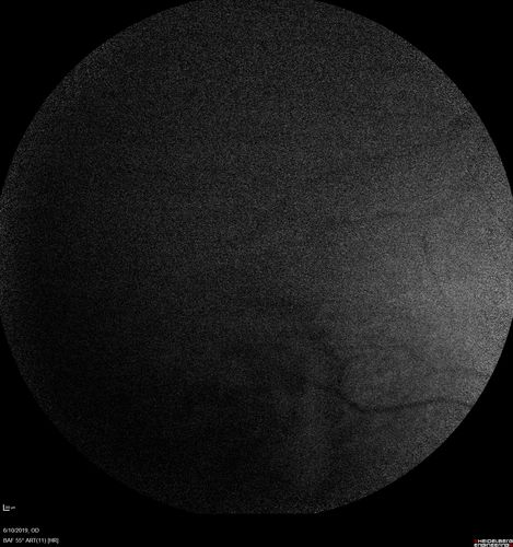 Melanosis Oculi and Choroidal Melanoma
88 year old female with 2.5 mm elevated choroidal melanoma and melanosis oculi.  She also has geographic atrophy from AMD.  The right eye is the better eye with 20/40 vision.  After observation with growth, brachytherapy was done.
