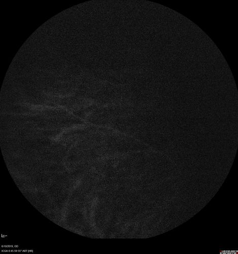Melanosis Oculi and Choroidal Melanoma
88 year old female with 2.5 mm elevated choroidal melanoma and melanosis oculi.  She also has geographic atrophy from AMD.  The right eye is the better eye with 20/40 vision.  After observation with growth, brachytherapy was done.

