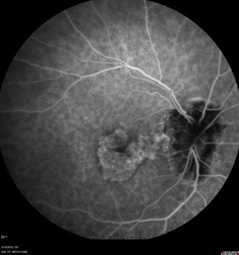 Melanosis Oculi and Choroidal Melanoma
88 year old female with 2.5 mm elevated choroidal melanoma and melanosis oculi.  She also has geographic atrophy from AMD.  The right eye is the better eye with 20/40 vision.  After observation with growth, brachytherapy was done.
