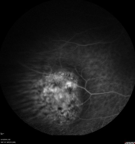 Melanosis Oculi and Choroidal Melanoma
88 year old female with 2.5 mm elevated choroidal melanoma and melanosis oculi.  She also has geographic atrophy from AMD.  The right eye is the better eye with 20/40 vision.  After observation with growth, brachytherapy was done.
