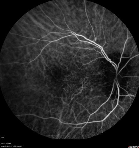Melanosis Oculi and Choroidal Melanoma
88 year old female with 2.5 mm elevated choroidal melanoma and melanosis oculi.  She also has geographic atrophy from AMD.  The right eye is the better eye with 20/40 vision.  After observation with growth, brachytherapy was done.
