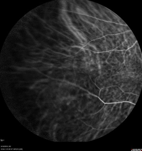 Melanosis Oculi and Choroidal Melanoma
88 year old female with 2.5 mm elevated choroidal melanoma and melanosis oculi.  She also has geographic atrophy from AMD.  The right eye is the better eye with 20/40 vision.  After observation with growth, brachytherapy was done.
