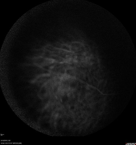 Melanosis Oculi and Choroidal Melanoma
88 year old female with 2.5 mm elevated choroidal melanoma and melanosis oculi.  She also has geographic atrophy from AMD.  The right eye is the better eye with 20/40 vision.  After observation with growth, brachytherapy was done.
