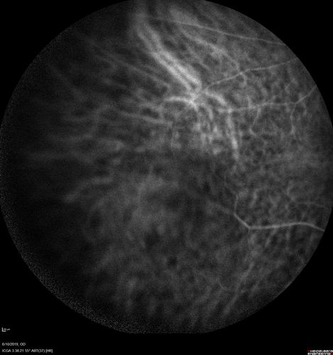 Melanosis Oculi and Choroidal Melanoma
88 year old female with 2.5 mm elevated choroidal melanoma and melanosis oculi.  She also has geographic atrophy from AMD.  The right eye is the better eye with 20/40 vision.  After observation with growth, brachytherapy was done.
