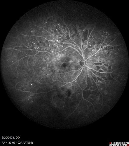 Severe NPDR with non-perfusion on FA
64 year old man with 20/32 vision in both eyes and mild blurring.  FA shows non-perfusion but no proliferation
