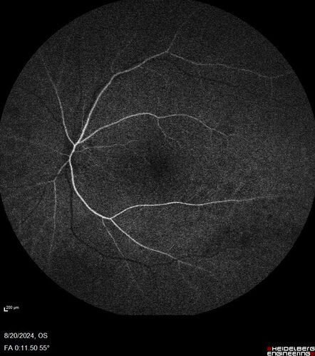 Severe NPDR with non-perfusion on FA
64 year old man with 20/32 vision in both eyes and mild blurring.  FA shows non-perfusion but no proliferation
