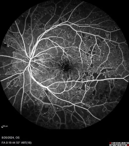 Severe NPDR with non-perfusion on FA
64 year old man with 20/32 vision in both eyes and mild blurring.  FA shows non-perfusion but no proliferation
