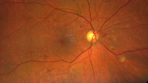 Severe NPDR
53 year old man with blurred vision (needs glasses).
Diabetic for 10 years with poor control
VA 20/32 OU
