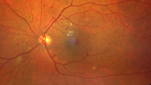 Severe NPDR
53 year old man with blurred vision (needs glasses).
Diabetic for 10 years with poor control
VA 20/32 OU
