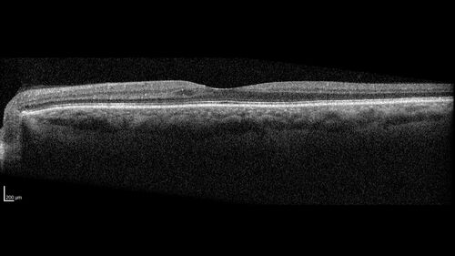 Severe NPDR
53 year old man with blurred vision (needs glasses).
Diabetic for 10 years with poor control
VA 20/32 OU
