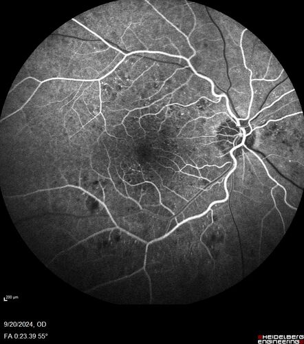 Severe NPDR
53 year old man with blurred vision (needs glasses).
Diabetic for 10 years with poor control
VA 20/32 OU
