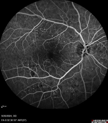 Severe NPDR
53 year old man with blurred vision (needs glasses).
Diabetic for 10 years with poor control
VA 20/32 OU
