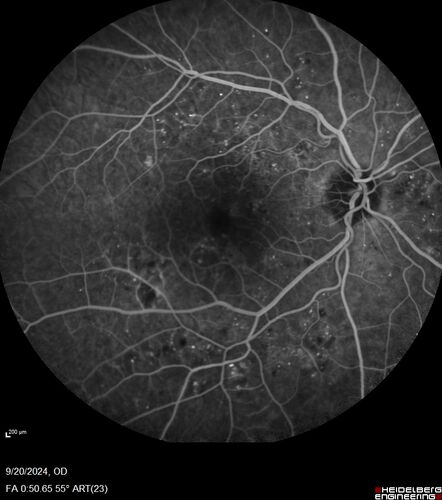 Severe NPDR
53 year old man with blurred vision (needs glasses).
Diabetic for 10 years with poor control
VA 20/32 OU
