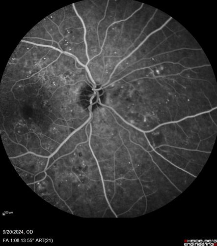 Severe NPDR
53 year old man with blurred vision (needs glasses).
Diabetic for 10 years with poor control
VA 20/32 OU
