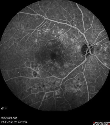 Severe NPDR
53 year old man with blurred vision (needs glasses).
Diabetic for 10 years with poor control
VA 20/32 OU
